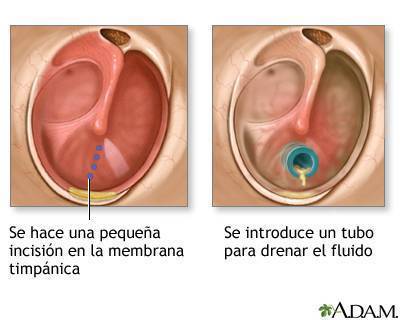 Drenaje en el oído