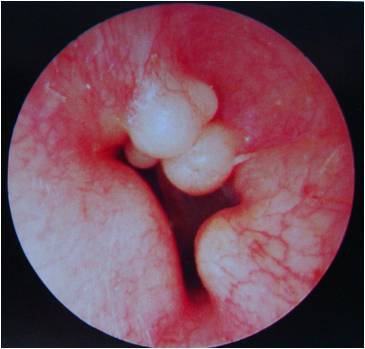 exostosis saturación