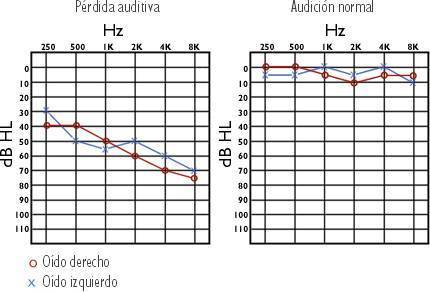 Audiogram_ES1